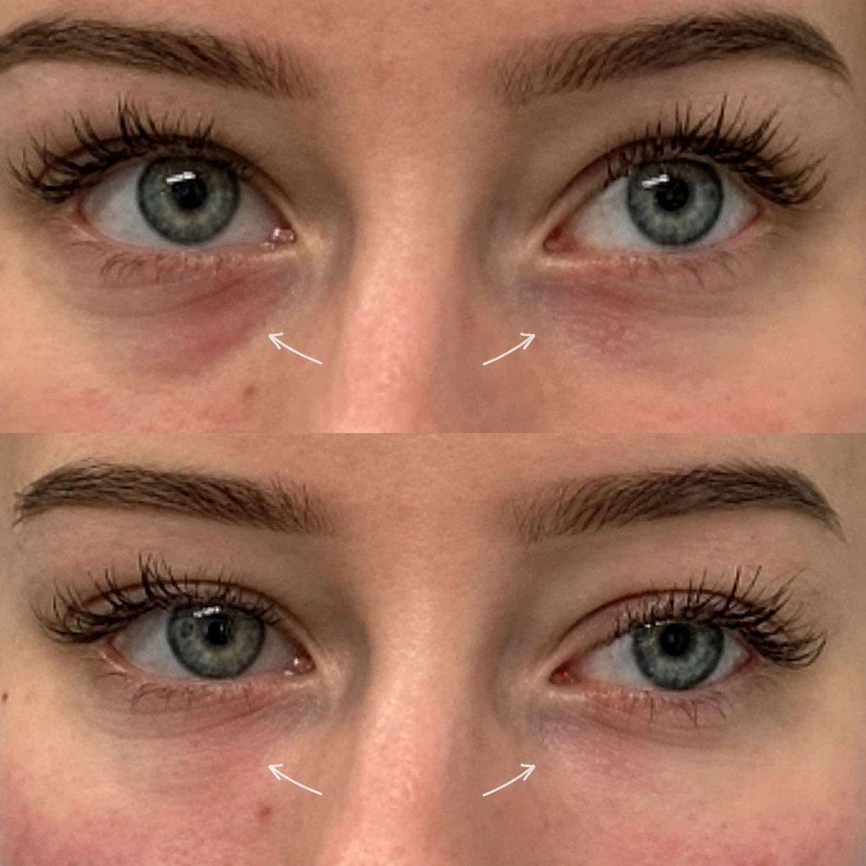 Resultaat van lipfillers