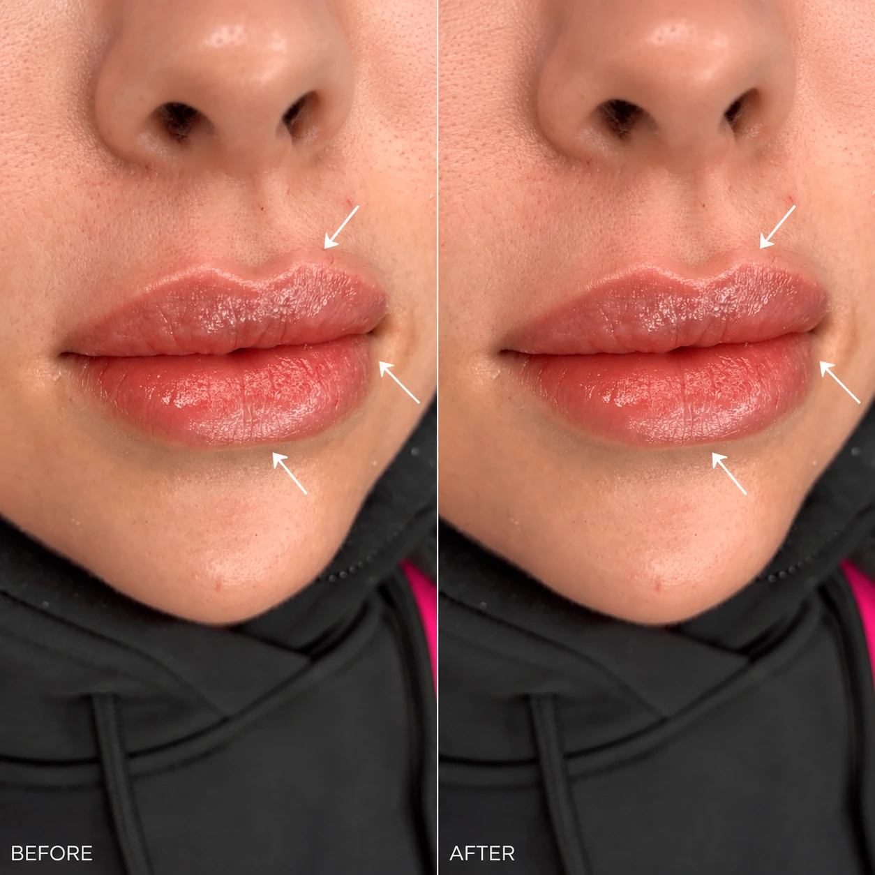 Lippen laten opvullen