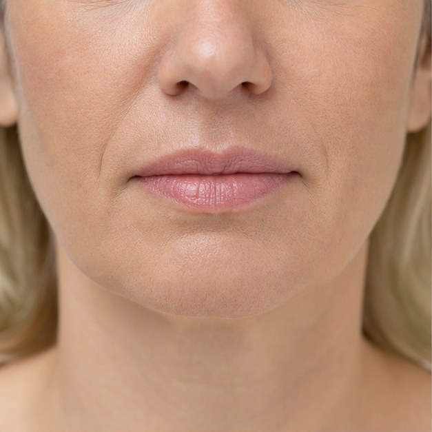 Behandeling van afhangende mondhoeken bij Liquid Beauty