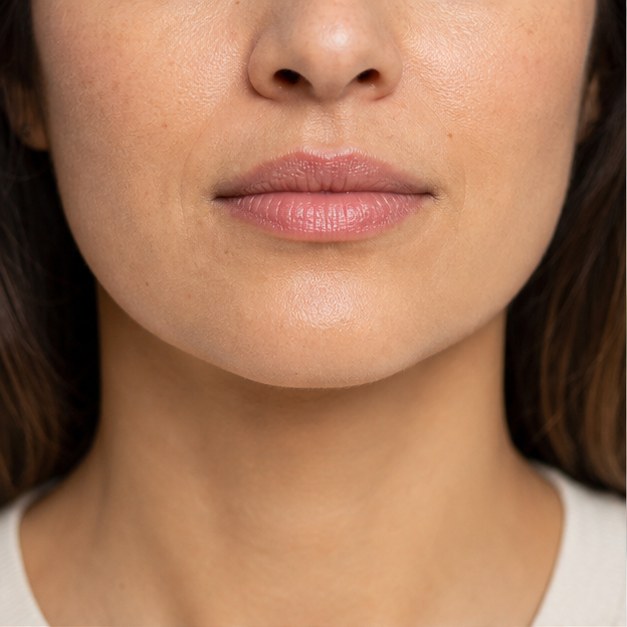 Kin fillers bij Liquid Beauty