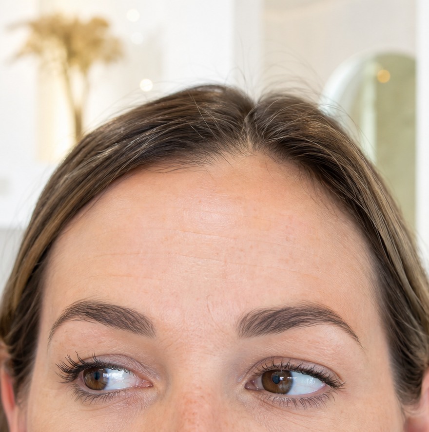 Voorhoofdsrimpels behandeling bij Liquid Beauty