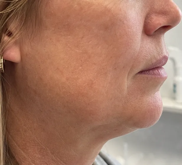 Indicatief resultaat Nithya Collagen 1
