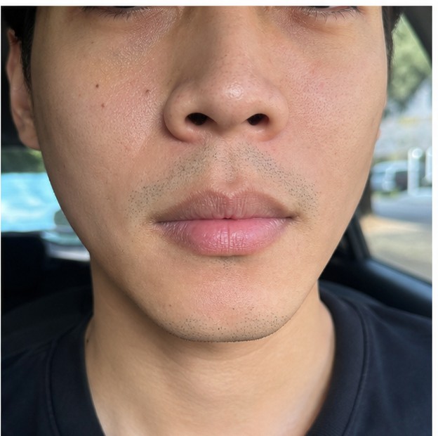 Indicatief resultaat lipflip 2