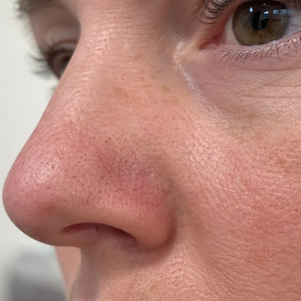 Couperose laserbehandeling