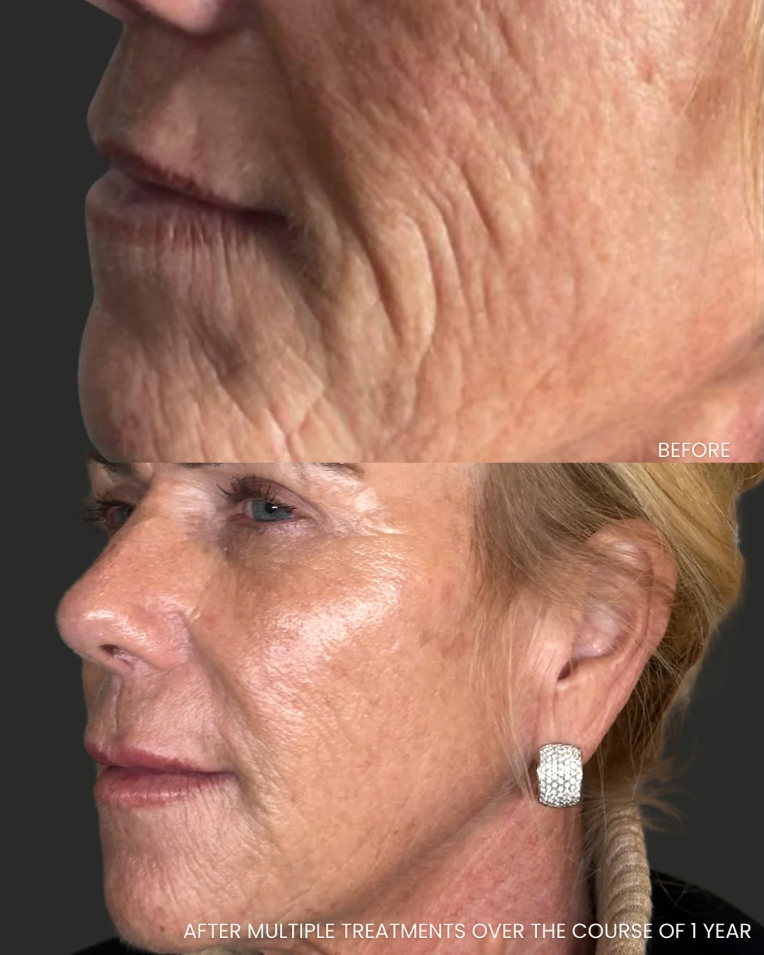 Voor-en-nafoto van Liquid Beauty