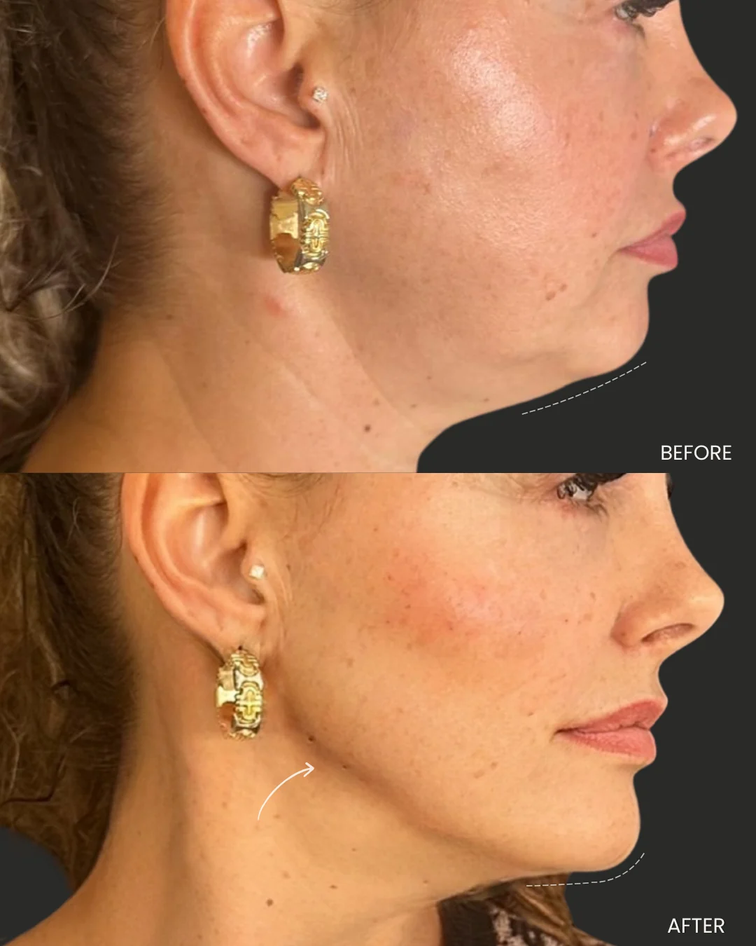 Voor-en-nafoto van Liquid Beauty
