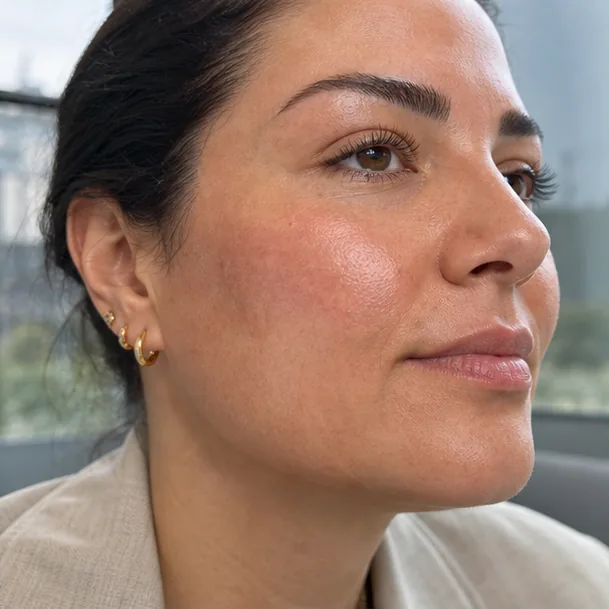 Indicatief resultaat LHALA Glass Skin Peel 3