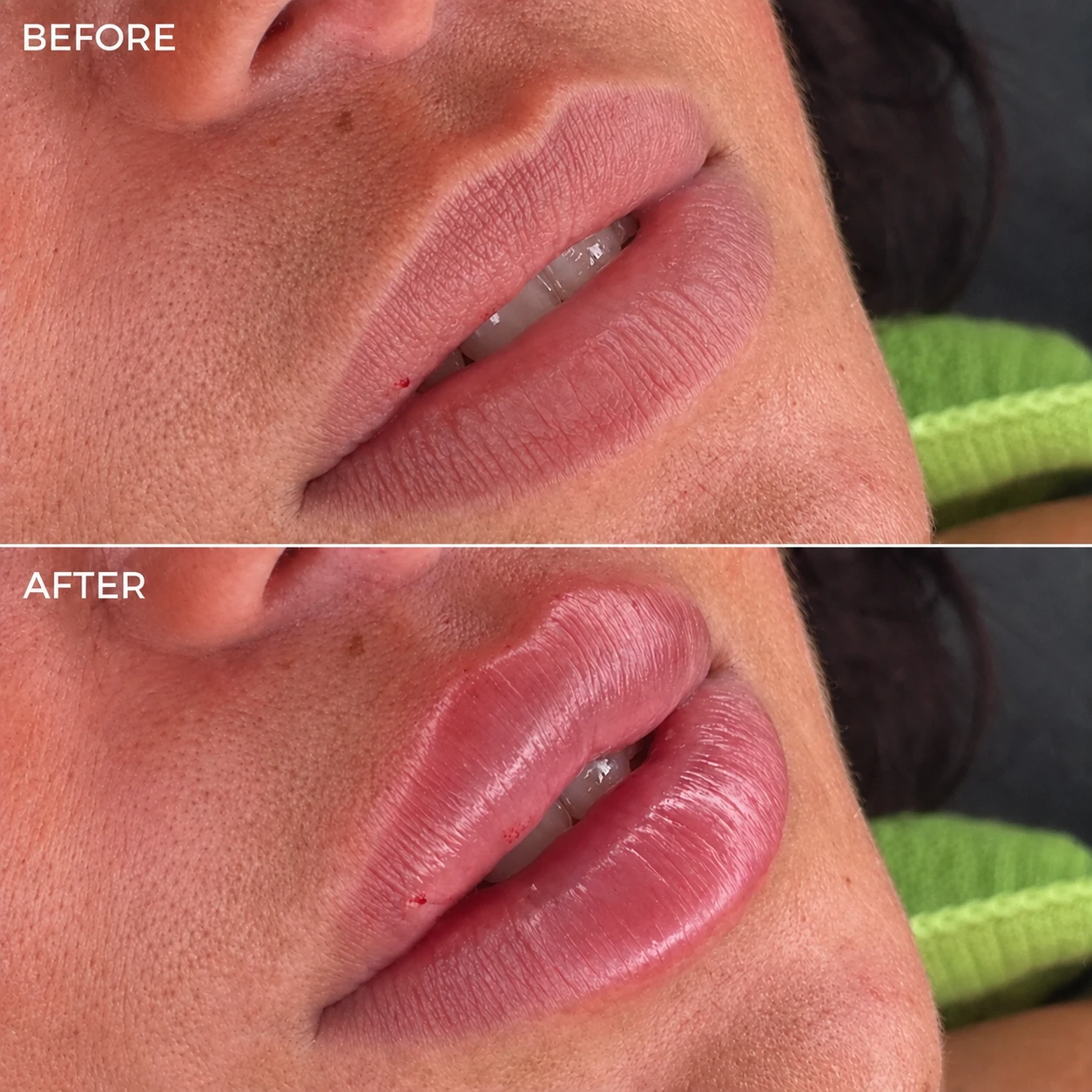 Voor-en-nafoto van een lipfillerbehandeling 1