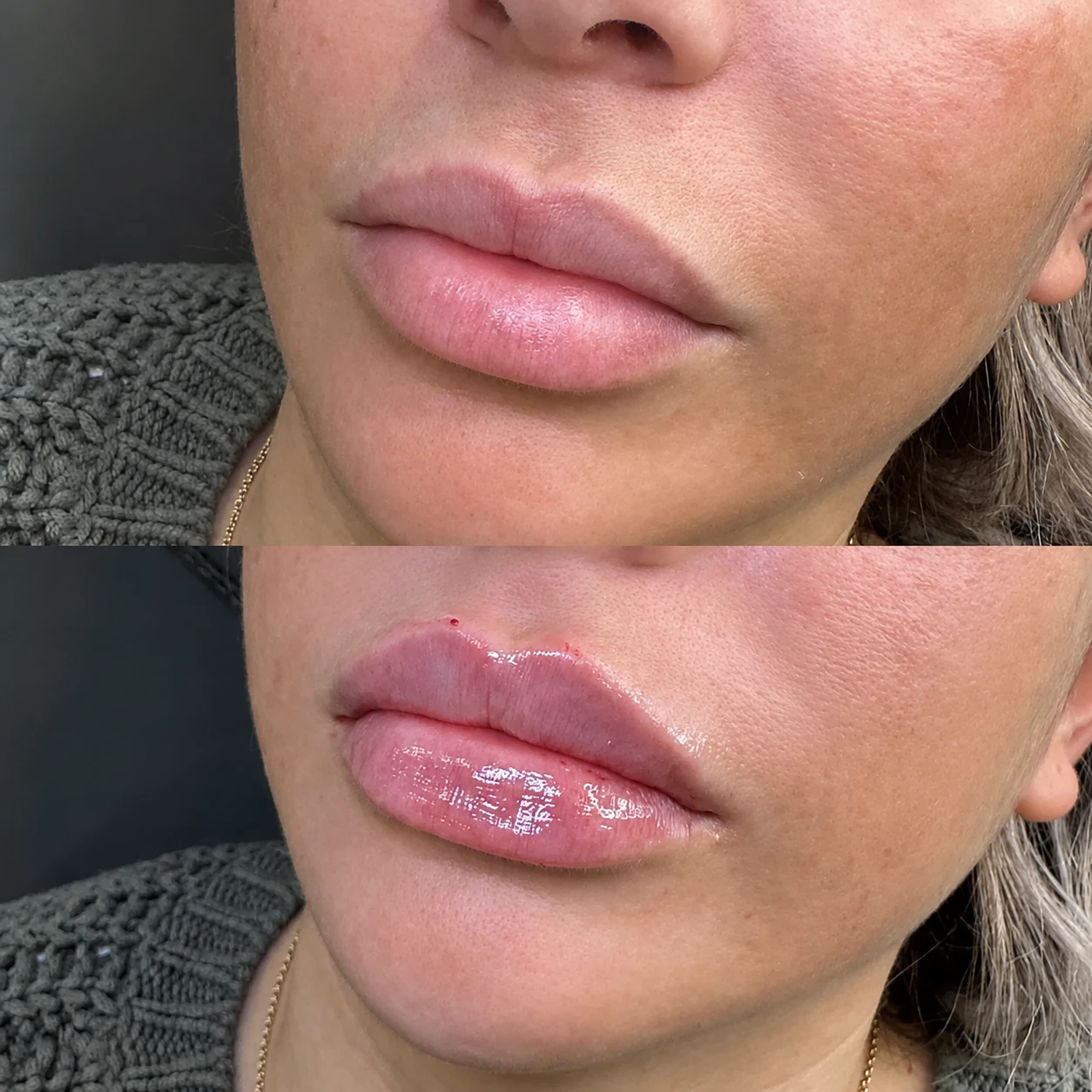 Voor-en-nafoto van een lipfillerbehandeling 2