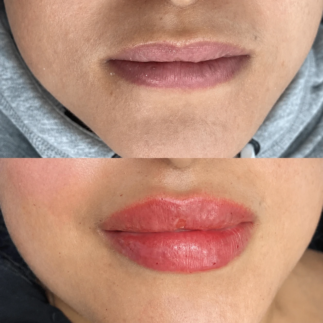 Voor-en-nafoto van een lipfillerbehandeling 4
