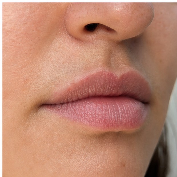 Indicatief resultaat lipflip 1