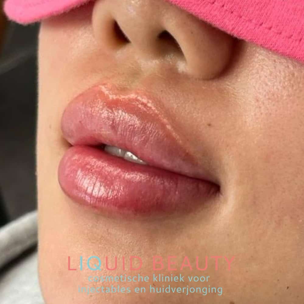 Lip fillers