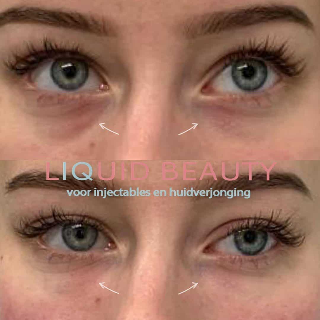 Fillers wallen 6