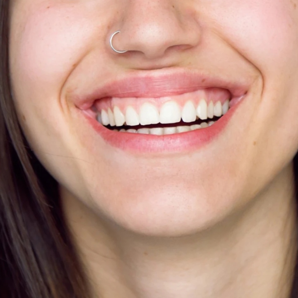 Gummysmile behandeling